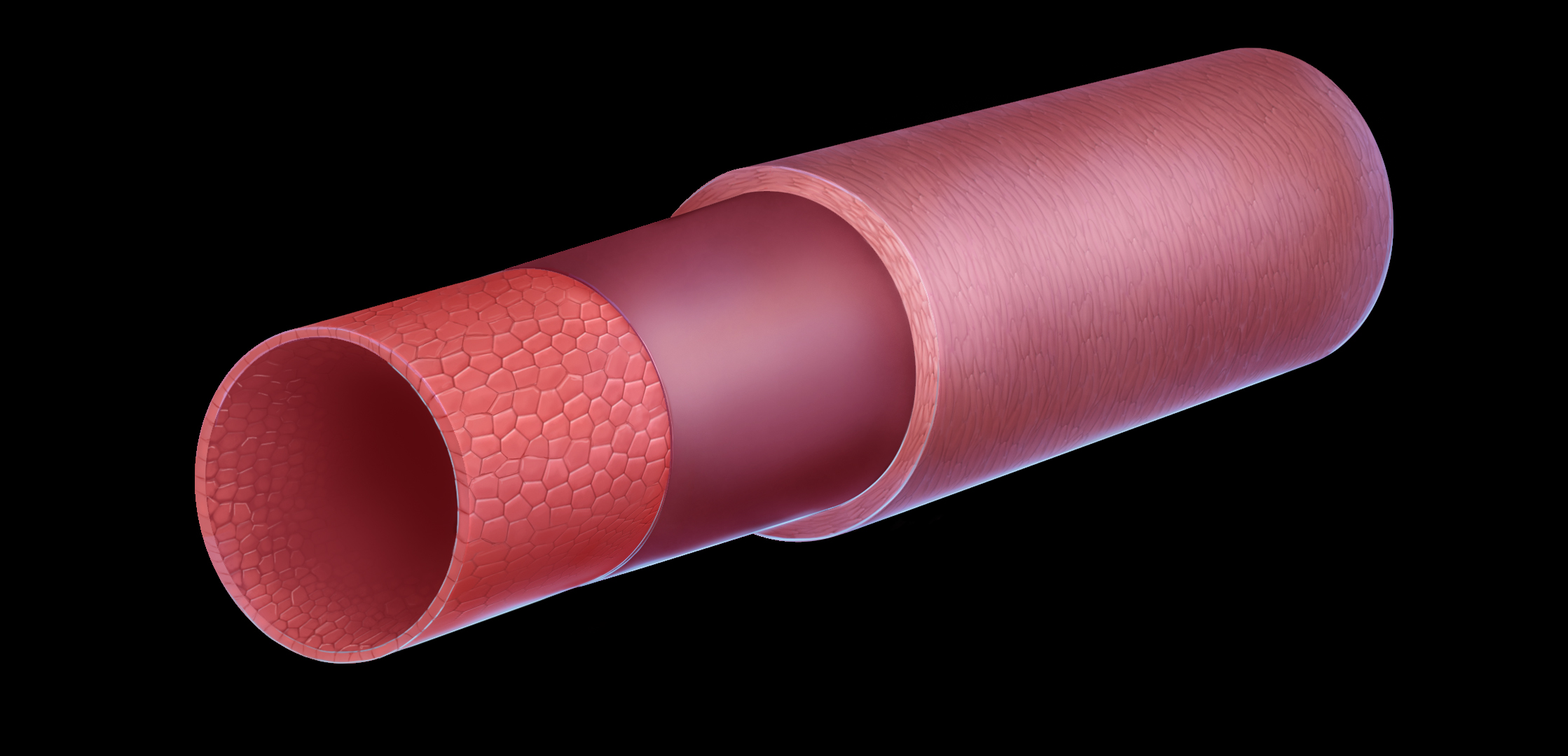 RFS stent creates new arterial tissue